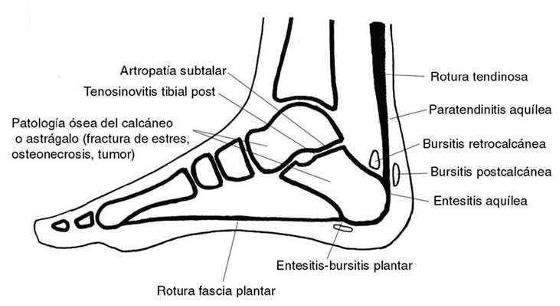 talalgia fascitis